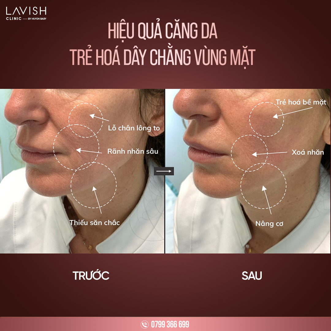 trẻ hóa dây chằng