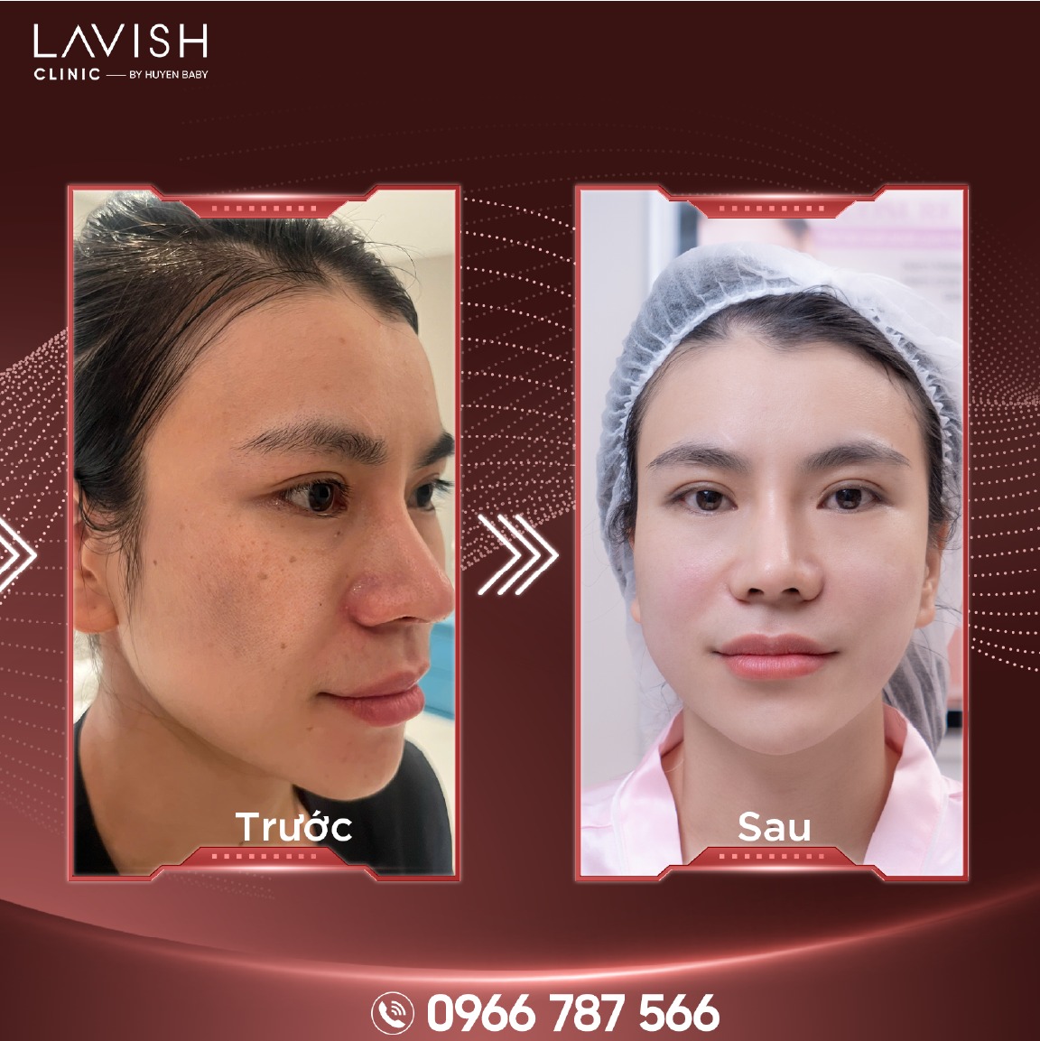Glowcell Potenza Lavish Clinic