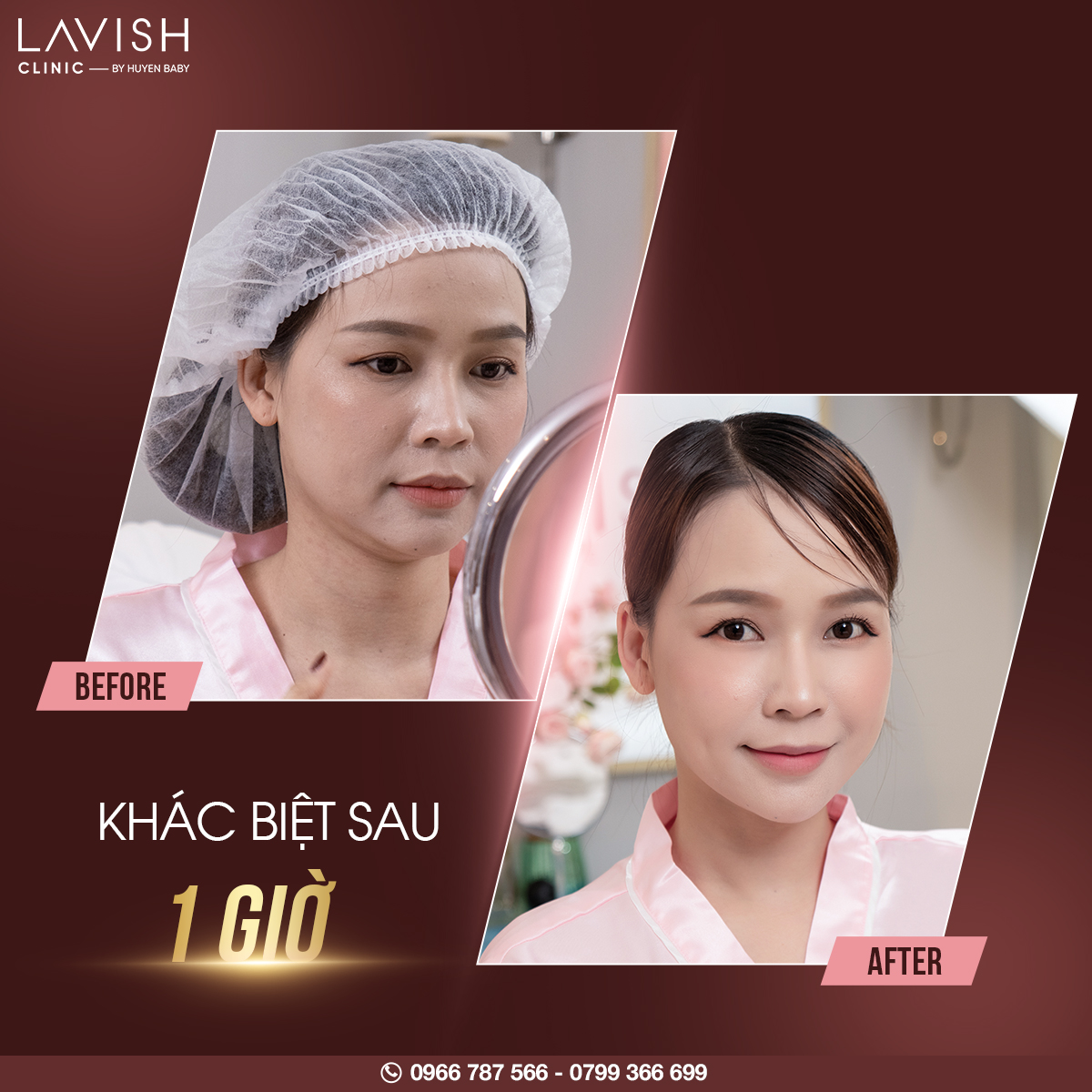 lavishclinictop1ultherapyprime