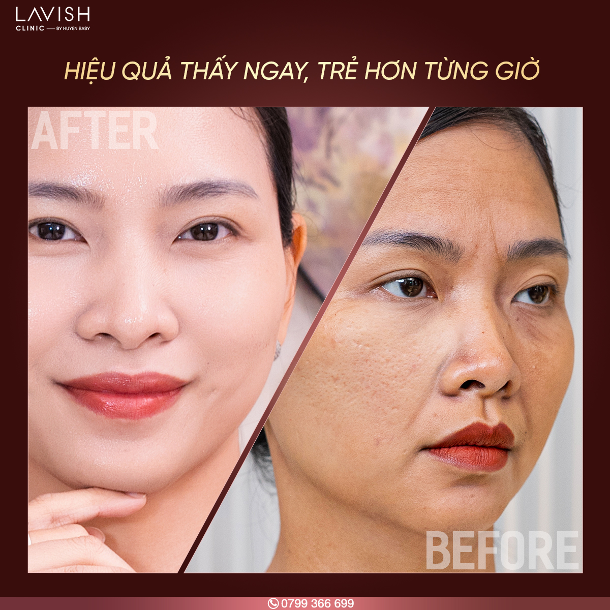 lavishclinic_sculptrix trẻ hóa