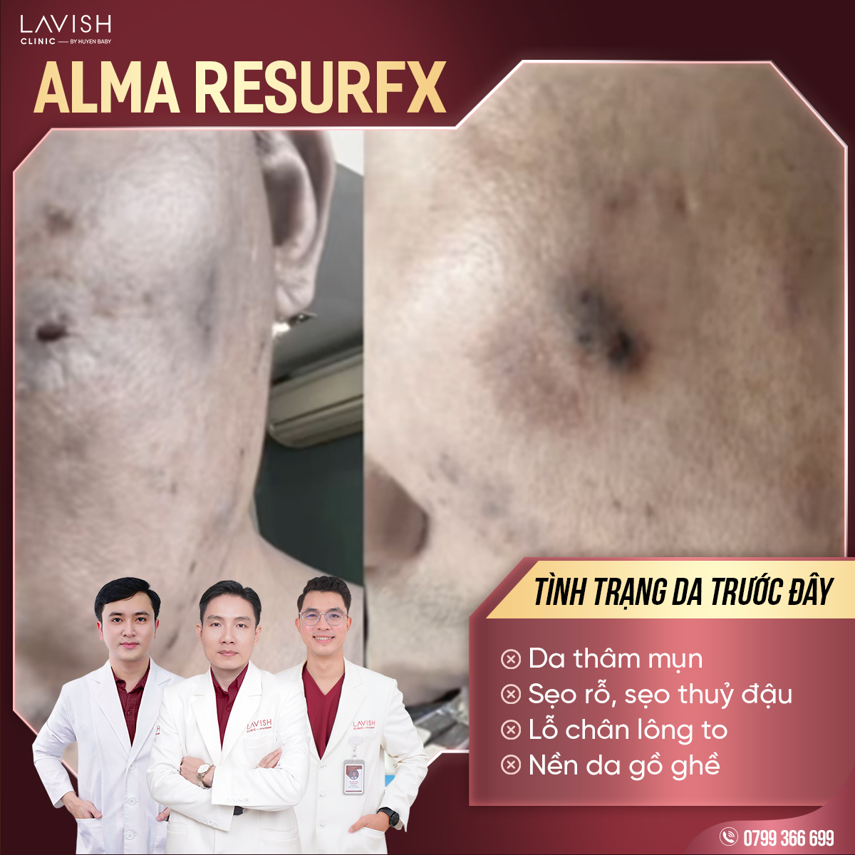 lavishclinictriseorohieuqua_almaresurfx