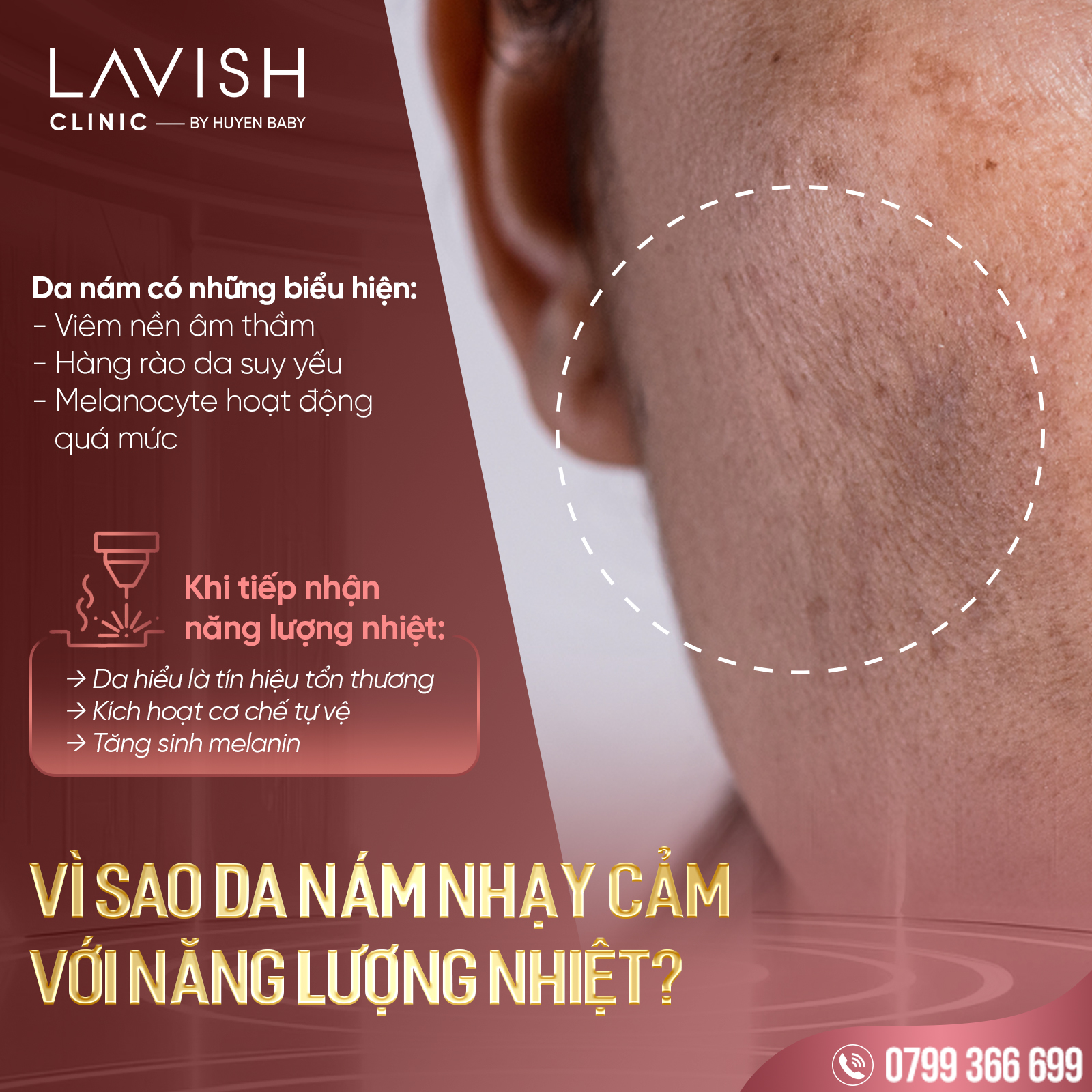 Trinamlaser_lavishclinicbyhuyenbaby