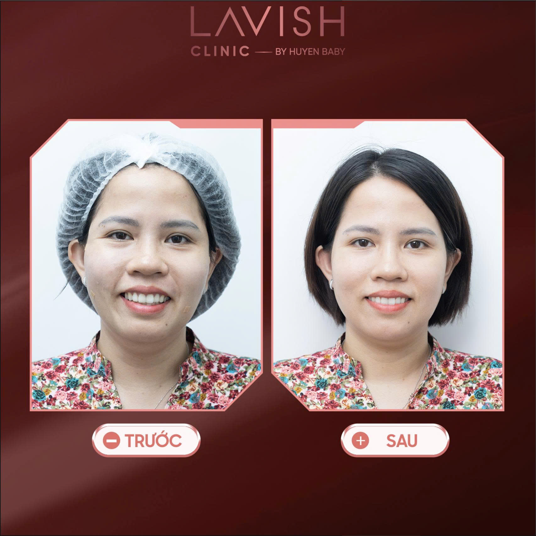 y-thuat-tre-hoa-da-tang-lavish-clinic.jpg