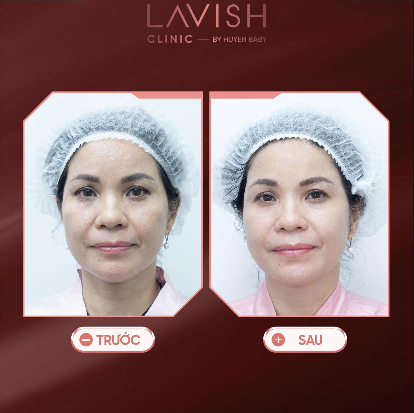 y-thuat-tre-hoa-da-tang-lavish-clinic.jpg