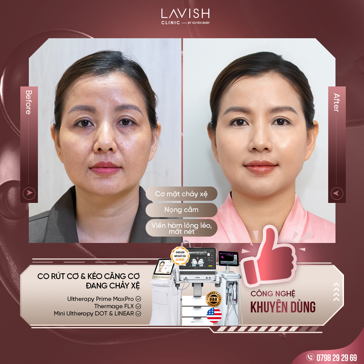 uudaitrehoa_vietkieu_lavishclinic